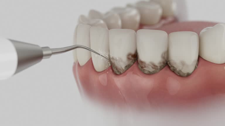 Trusted Wisdom Tooth Removal service in Hammond, LA - Dentist Open Now